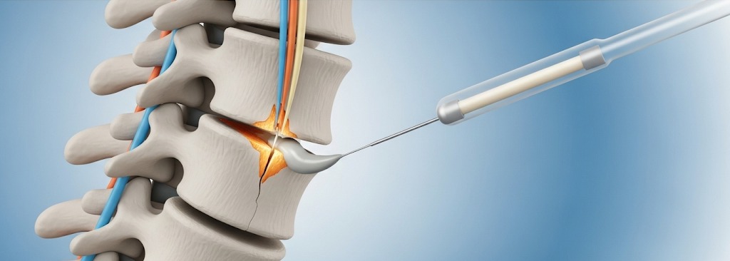 Vertebroplasty