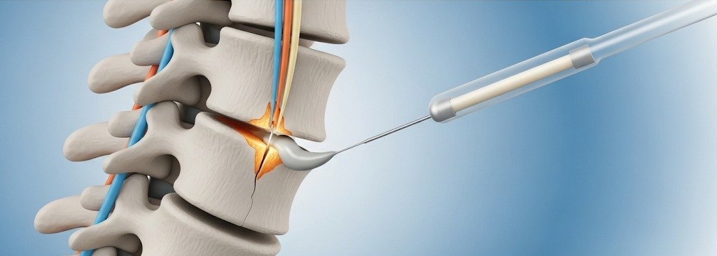 Vertebroplasty